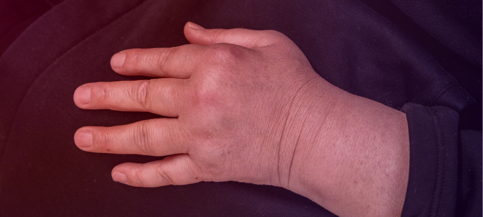 patient centricity in rheumatoid arthritis clinical trials