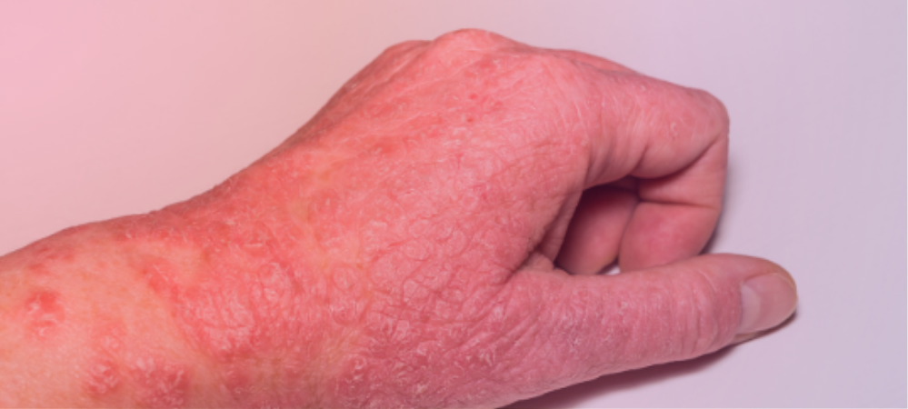 atopic dermatitis immune dysregulation