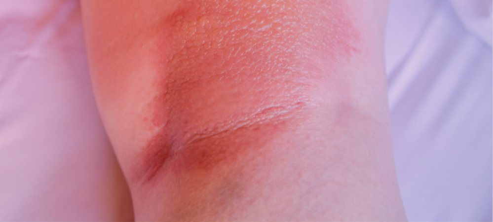 atopic dermatitis skin barrier dysfunction