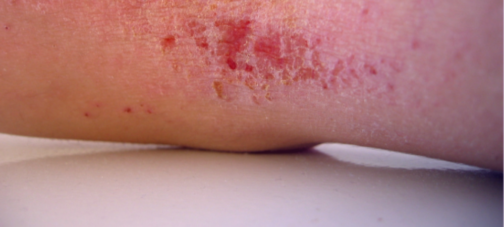 clinical outcome assessments in atopic dermatitis
