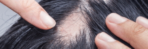 alopecia areata assessment tool