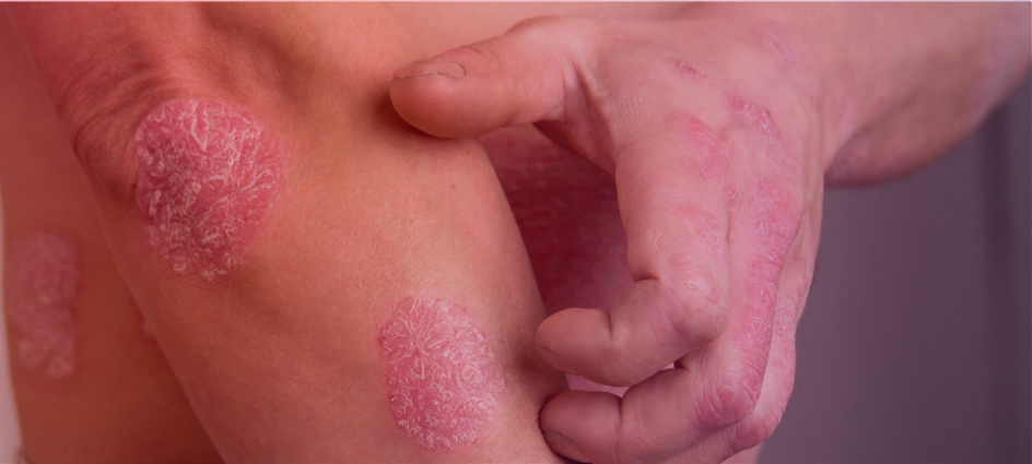 clinical outcome assessments in psoriasis